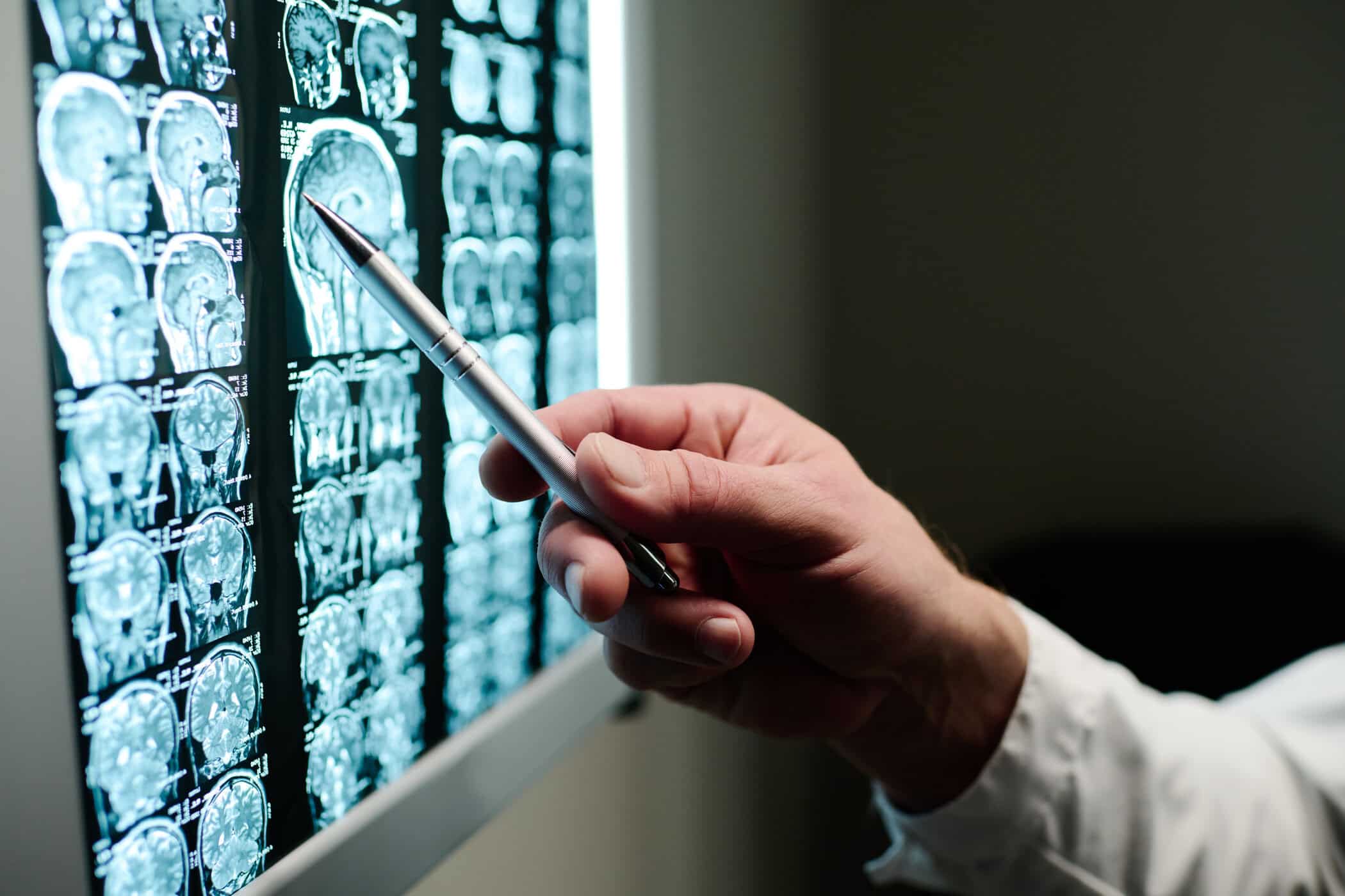 Claude hat geantwortet: Arzt zeigt mit Stift auf Gehirn-MRT-Aufnahmen – Forschung zur Verbindung zwischen ADHS und Alzheimer.Arzt zeigt mit Stift auf Gehirn-MRT-Aufnahmen – Forschung zur Verbindung zwischen ADHS und Alzheimer.